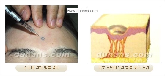 [두한성형외과 함몰 흉터 교정] - [동시에 3가지 시술로 효과적인 흉터의 교정 안내 ①] 관련 이미지 1