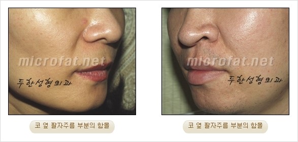 [두한성형외과 경쟁력 미세지방이식] - [귀족수술 입체 미세지방이식] 관련 이미지 3