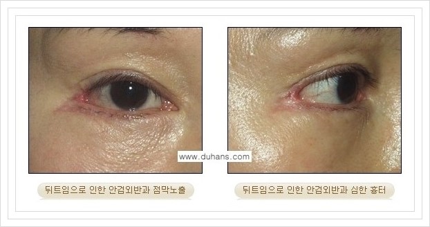 [두한성형외과 경쟁력 쌍꺼풀 재수술, 극한 눈재수술] - [뒤트임 부작용과 뒤트임 교정수술 방법 안내] 관련 이미지 8