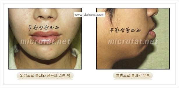 [두한성형외과의 경쟁력 미세지방이식] - [무턱교정, 턱 미세지방이식 안내 1.] 관련 이미지 3