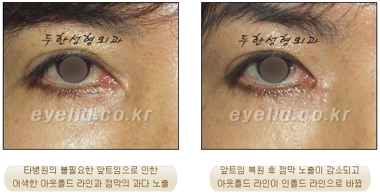 [두한성형외과 눈재수술] - [성공적인 수술] 관련 이미지 4