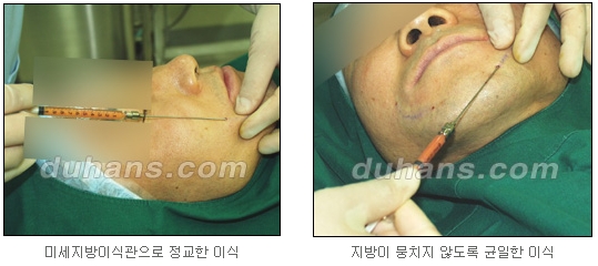 [두한성형외과 얼굴자가지방이식] - [지방이식 과정] 관련 이미지 6