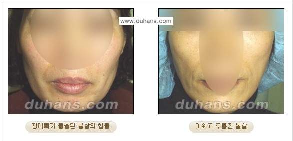 [두한성형외과 경쟁력 미세지방이식] - [볼살, 이마, 측두부 - 안면윤곽 미세지방이식] 관련 이미지 2