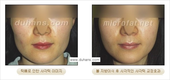[두한성형외과 경쟁력 미세지방이식] - [볼살, 이마, 측두부 - 안면윤곽 미세지방이식] 관련 이미지 16