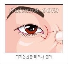 [두한성형외과 경쟁력 눈성형] - [흉터없는 몽고주름 제거술(앞트임) 관련 이미지 8