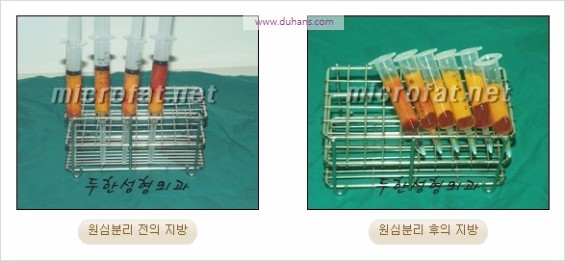 [두한성형외과 경쟁력 동안성형 리더] - ​[미간주름, 이마주름, 안검성형, 이마거상술, 눈썹거상술] 관련 이미지 28