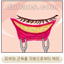 [두한성형외과 안검성형] - [상안검, 하안검] 관련 이미지 18