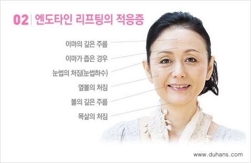 [두한성형외과 경쟁력 다크써클 치료] - [다크써클 + 엔도타인 리프팅 콤비 프로그램] 관련 이미지 4