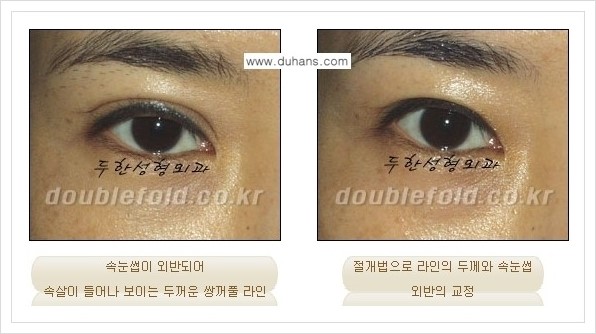 [두한성형외과 경쟁력 쌍꺼풀 재수술, 극한 재수술] - [망가진 눈 복원수술 - 속눈썹 외반 교정 안내] 관련 이미지 4