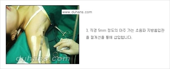 [두한성형외과 성형 FOCUS 지방흡입] - [액취증 - 다한증 초음파 컷터 지방흡입 ③] 관련 이미지 10