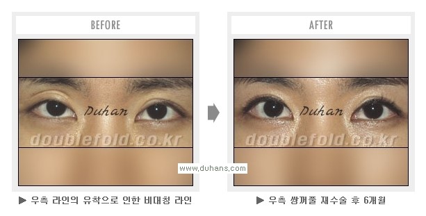[두한성형외과 Dr. 컬럼] - [쌍꺼풀 재수술(눈 재수술)의 목적] 관련 이미지 6