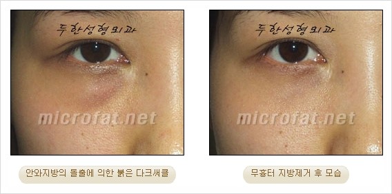 [두한성형외과 쌍커풀수술] - [눈성형 방법에 대한 자주하는 질문과 답변] 관련 이미지 191