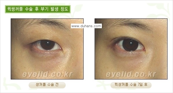 [두한성형외과 경쟁력 눈성형] - [퀵쌍꺼풀(부분절개법) 수술 안내] 관련 이미지 10