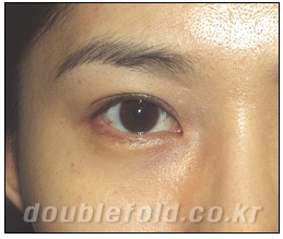 [Dohan Plastic Surgery Double Eyelid Surgery] - [Beautiful Double Eyelids] image 3