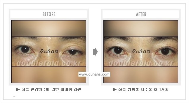 [두한성형외과 경쟁력 쌍꺼풀 재수술(극한 재수술)] - [피부 여유분이 부족해서 토안증이 발생한 경우의 문제점 해결 안내] 관련 이미지 2