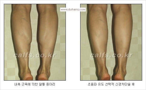 [두한성형외과 Dr. 컬럼] - [종아리 근육퇴축술로 가장 선호하는 비절개 초음파 유도 선택적 신경차단술] 관련 이미지 16