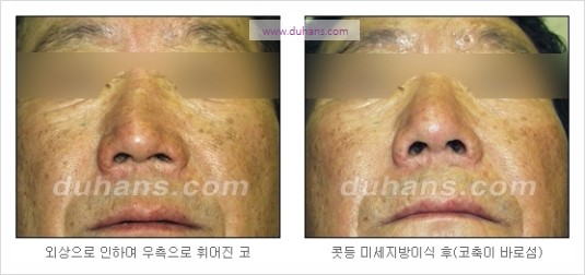 [두한성형외과 경쟁력 코성형] - [코를 높히는 지방이식] 관련 이미지 10