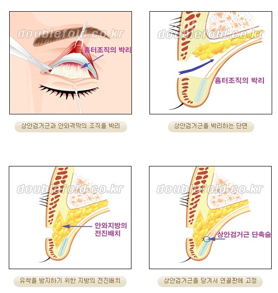 과교정 눈매 (소세지 쌍커풀 재수술, 눈매교정 재수술) 관련 이미지 5