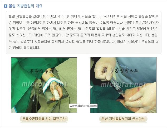 [두한성형외과 겨울엔 지방흡입을] - [통통한 볼살, 두툼한 턱선의 지방흡입 1.] 관련 이미지 3