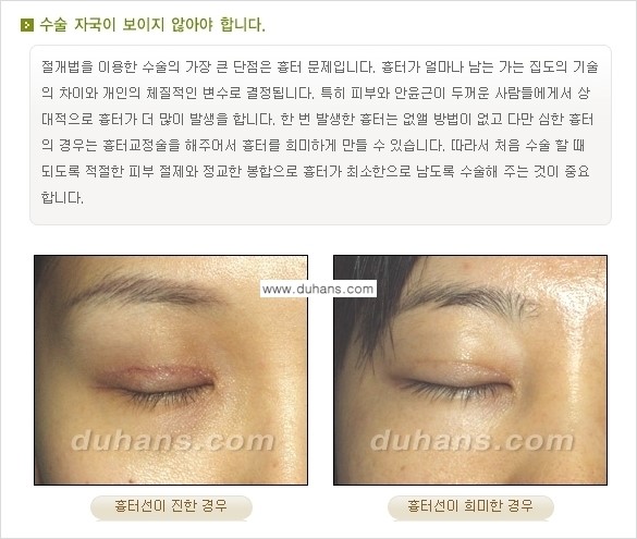 [두한성형외과 경쟁력 눈성형] - [매력적인 쌍꺼풀이란?] 관련 이미지 4