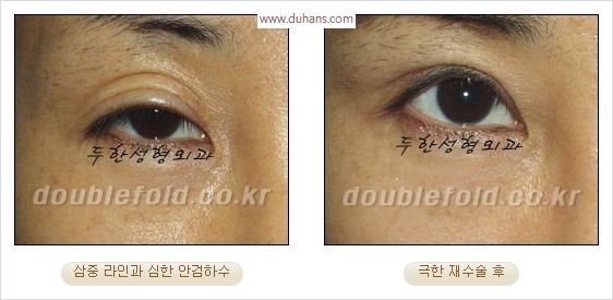 [두한성형외과 경쟁력 눈성형] - [극한 재수술, 함몰된 눈꺼풀 라인교정, 안검하수(졸리운 눈매)] 관련 이미지 26