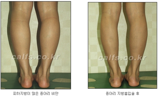 두한성형외과 지방흡입 - 부위별 안전 지방흡입 관련 이미지 34