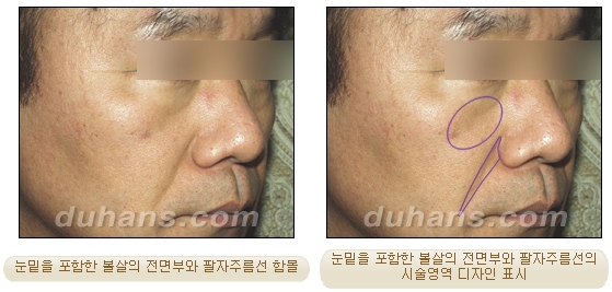 [두한성형외과 얼굴자가지방이식] - [귀족수술 입체 미세지방이식] 관련 이미지 6