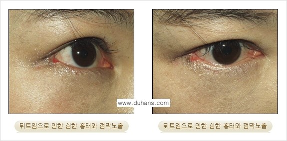 [두한성형외과 경쟁력 눈성형] - [뒤트임 수술 부작용 안내] 관련 이미지 12