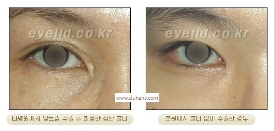 ​[두한성형외과 경쟁력 눈매성형] - [눈의 가로길이를 키우는 앞트임, 뒤트임 수술] 관련 이미지 6