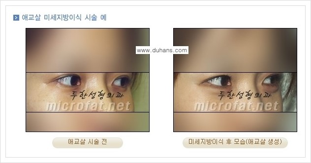 [두한성형외과 경쟁력 눈밑성형] - [눈밑 애교살 시술 안내 1.] 관련 이미지 3