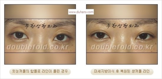 [두한성형외과 경쟁력 눈성형] - [쌍꺼풀 재수술 과정과 쌍꺼풀 재수술 실패의 원인, 쌍꺼풀 재수술의 성공 요건] 관련 이미지 49