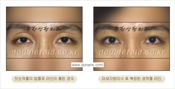 [두한성형외과 경쟁력 눈성형] - [미세지방이식으로 풀린 라인의 교정 방법 안내] 관련 이미지 2