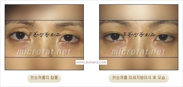 [두한성형외과 경쟁력 쌍꺼풀 재수술, 극한 눈재수술] - [어색한 쌍꺼풀 라인을 교정하는 윗눈꺼풀 미세지방이식] 관련 이미지 15