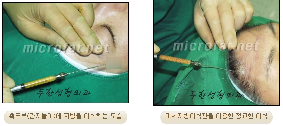 [두한성형외과 얼굴지방이식] - [측두부, 관자놀이] 관련 이미지 6