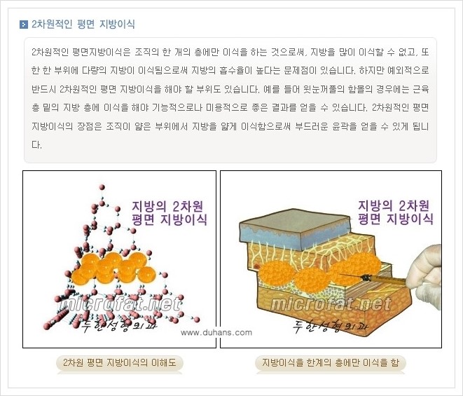 [두한성형외과 경쟁력 미세지방이식] - [3차원 입체 미세지방이식 안내] 관련 이미지 1
