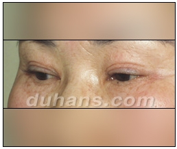 눈성형잘하는곳 두한성형외과 - 겹쌍꺼풀 관련 이미지 2
