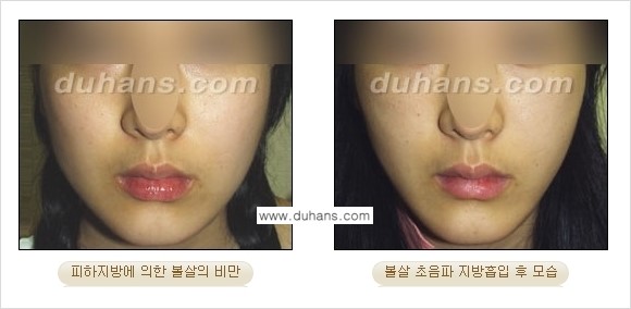 ​​​﻿[두한성형외과 경쟁력 간편지방흡입] - [볼살지방흡입, 턱선지방흡입 안내] 관련 이미지 9