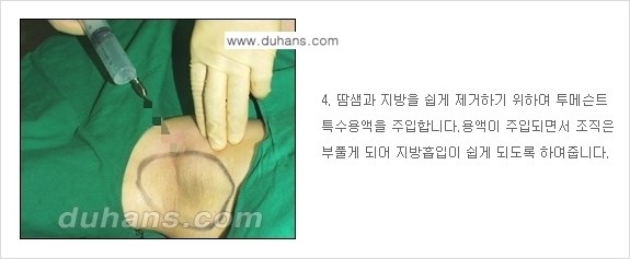 [두한성형외과 성형 FOCUS 지방흡입] - [액취증 - 다한증 초음파 컷터 지방흡입 ④] 관련 이미지 5