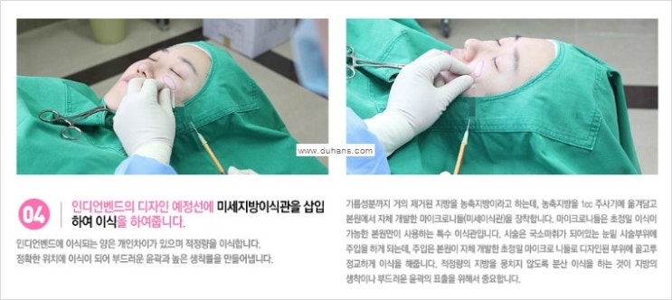 [두한성형외과 경쟁력 눈밑성형] - [눈밑 다크써클 치료 - 다크써클 + 인디언밴드 콤비 프로그램] 관련 이미지 6