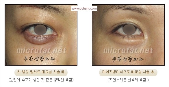 [두한성형외과 경쟁력 눈밑성형] - [타 병원 필러 애교살 시술 부작용을 미세지방이식으로 교정] 관련 이미지 3