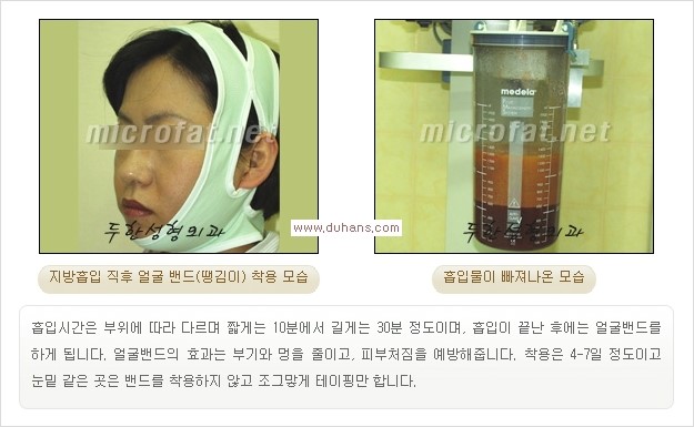 [두한성형외과 경쟁력 미세지방이식] - [타병원에서의 미세지방이식 이후 부작용 교정의 대상 안내] 관련 이미지 15