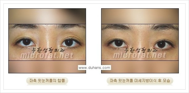 [두한성형외과의 경쟁력 미세지방이식] - [꺼진 눈꺼풀(윗눈꺼풀 함몰) 미세지방이식 안내] 관련 이미지 10