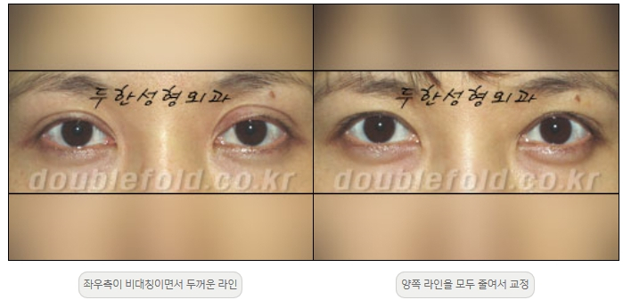 [두한성형외과 쌍커플재수술] - [비대칭 쌍커풀 라인] 관련 이미지 15