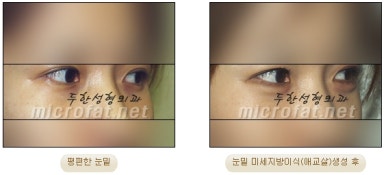 Fat Grafting Leader Duhan Plastic Surgery - Everything About Fat Grafting image 12