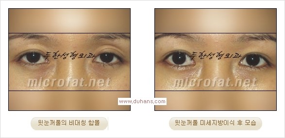 [두한성형외과 Dr. 컬럼] - [눈꺼풀의 지방이식] 관련 이미지 10