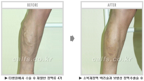 [종아리성형 두한성형외과] - [종아리수술에 대한 자주하는 질문과 답변 모음] 관련 이미지 24