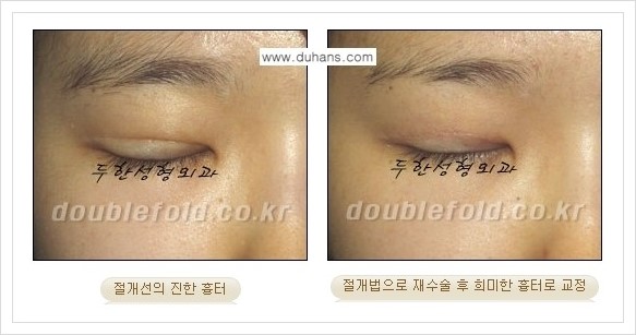 [두한성형외과 경쟁력 쌍꺼풀(눈) 재수술] - [쌍꺼풀 흉터선이 진한 경우의 안내] 관련 이미지 4