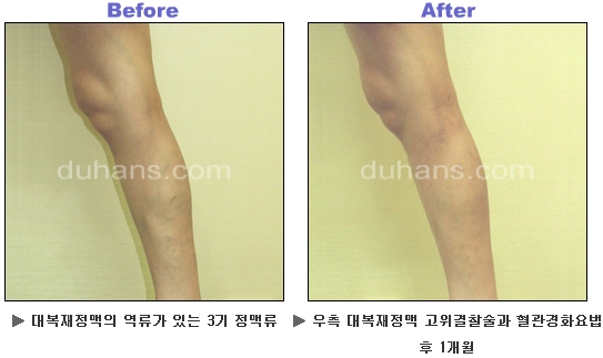 [두한성형외과 정맥류] - [하지정맥류, 정맥확장증, 혈관확장증] 관련 이미지 41