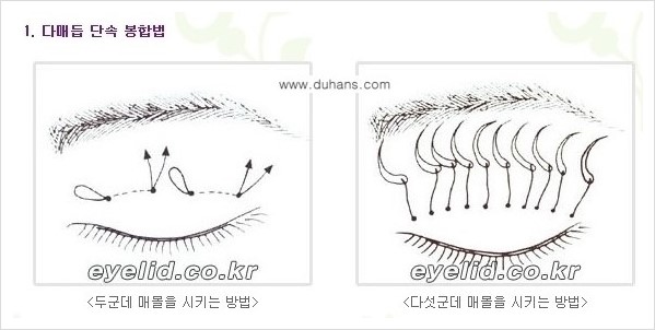 [두한성형외과 경쟁력 눈성형] - [절개법, 매몰법의 수술 방법] 관련 이미지 5