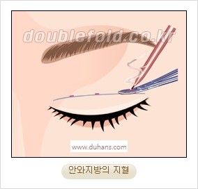 [두한성형외과 경쟁력 눈성형] - [자연스럽고 아름다운 눈매를 만드는 여러 가지 눈성형 방법] 관련 이미지 10